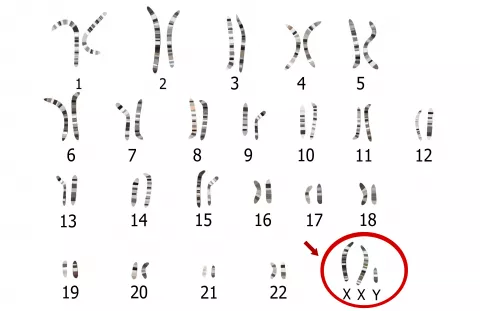 Diagnóstico del síndrome de Klinefelter