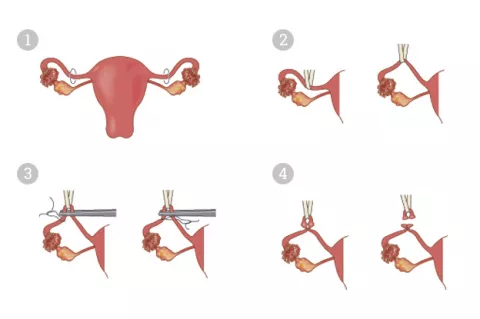 Tipos de cirugía en la ligadura de trompas