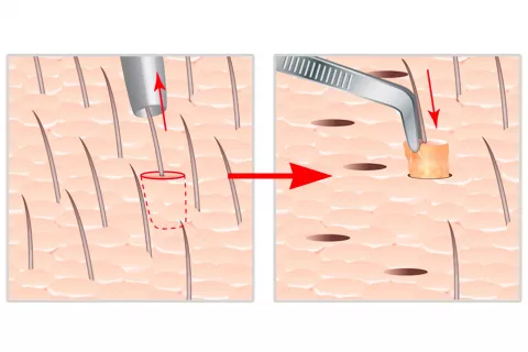 Micro injerto de vello en el pubis