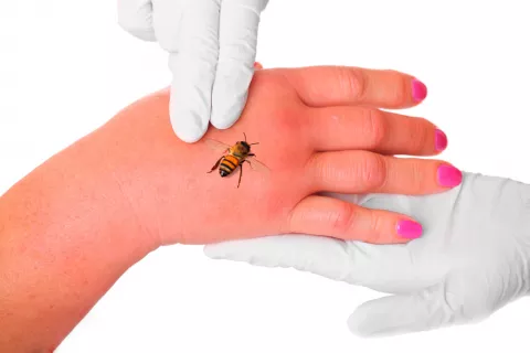 Doctor sujetando la mano del paciente mientras la abeja inocula su veneno