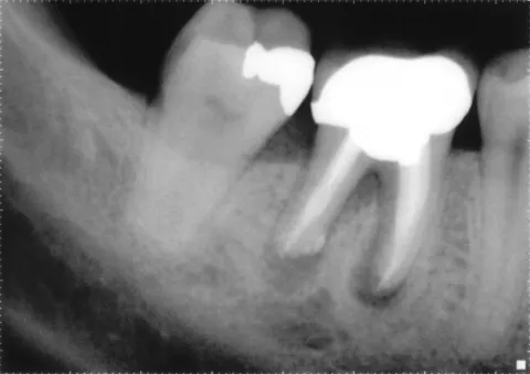 Procedimientos asociados a la endodoncia