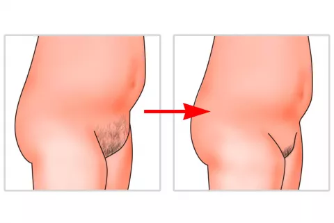 Liposucción del Monte de Venus