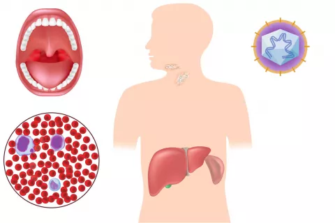 Síntomas ligados a la mononucleosis infecciosa