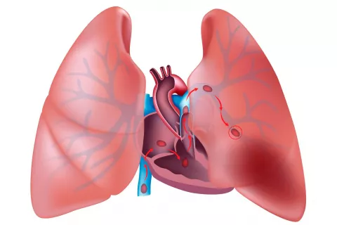 Síntomas del tromboembolismo pulmonar