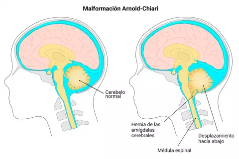 Causas de la siringomielia en el cerebro