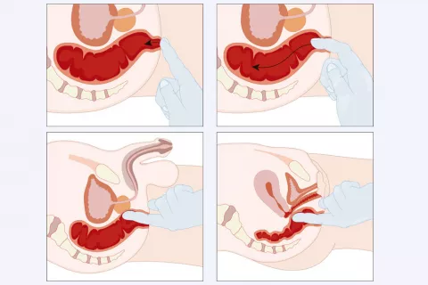 Ilustración de cómo se hace el tacto rectal