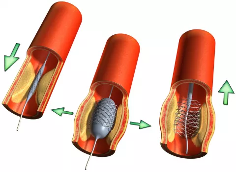 Tratamiento de la arteriosclerosis