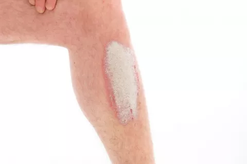 Tratamiento de una dermatitis atópica