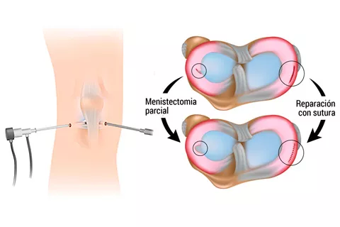 Gráfico de una artroscopia para reparar un menisco