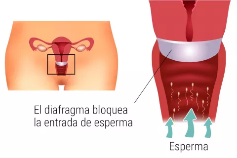 Ilustración de la colocación y uso del diafragma vaginal