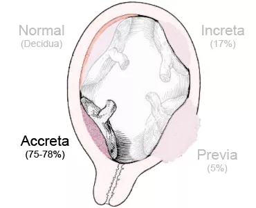 Dibujo de placenta accreta