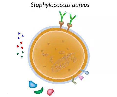 Staphylococcus aureus causa de bronquiectasias