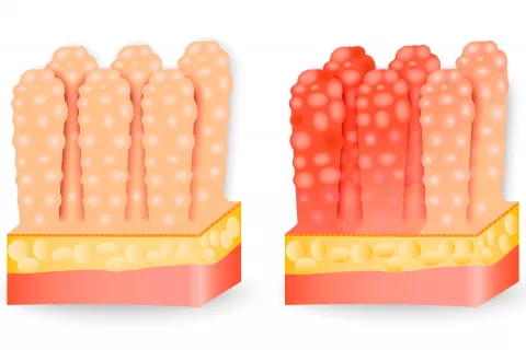 Causas de la gastroenteritis aguda