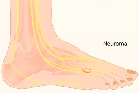 Origen y causas del neuroma de Morton