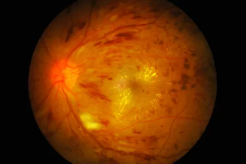 Retina afectada por retinosis pigmentaria