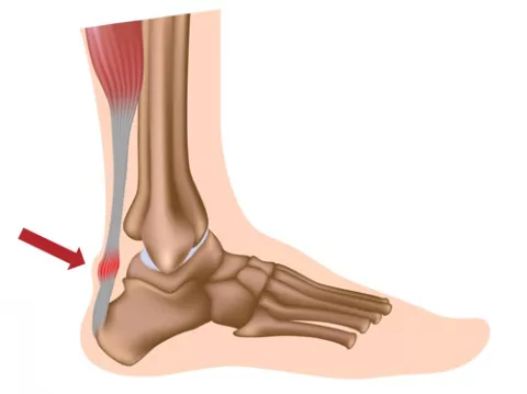 Gráfico de los síntomas de una tendinitis