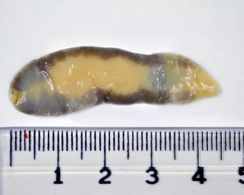 Fasciola de 4cm de longitud