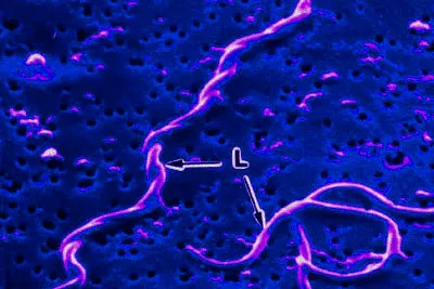 bacteria llamada Haemophilus ducreyi