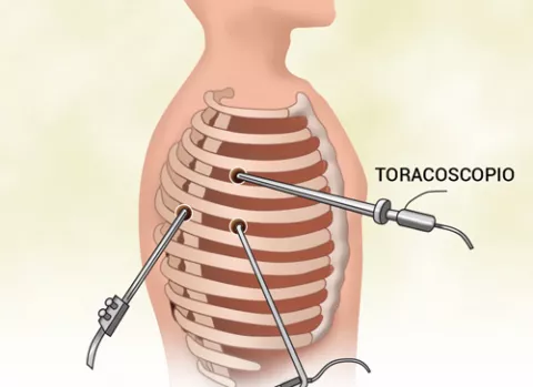 Dibujo muestra cómo se hacen las incisuras en la pared abdominal