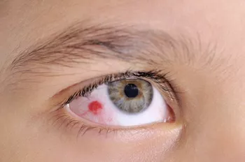 Señal de un cuerpo extraño en ojos