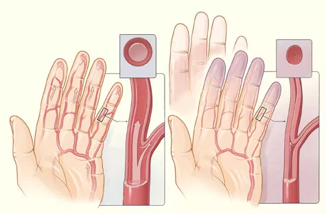 Síntomas de esclerodermia