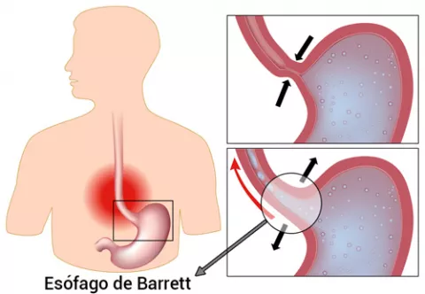 Gráfico del esófago de Barrett