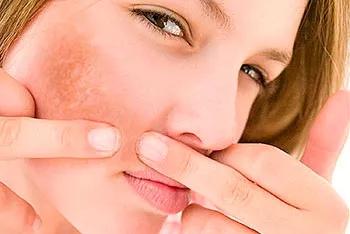 Melasma facial