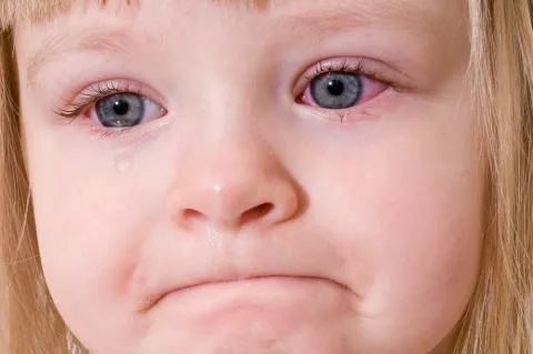 Niña pequeña con conjuntivitis