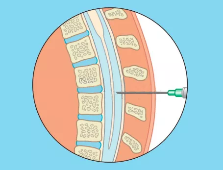 Punción lumbar