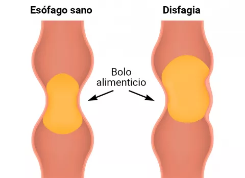 Disfagia: ilustración