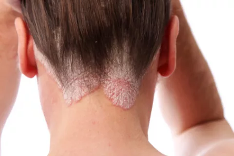 Mujer con síntomas de psoriasis en la nuca