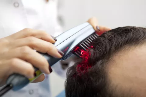 Microinjertos de pelo y plasma enriquecido para la alopecia