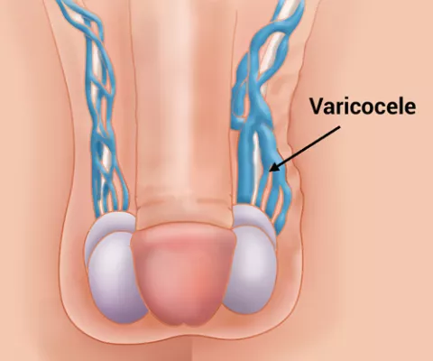 Gráfico del varicocele