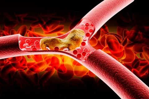 Arteriosclerosis, cuida bien tus arterias