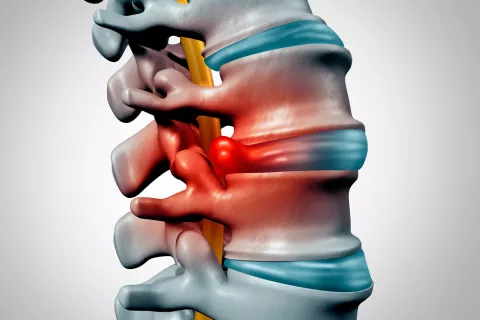 Hernia discal