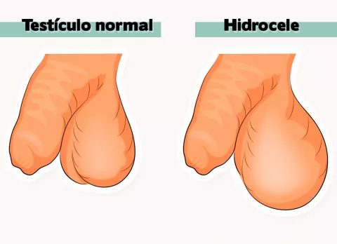 Hidrocele (ilustración)