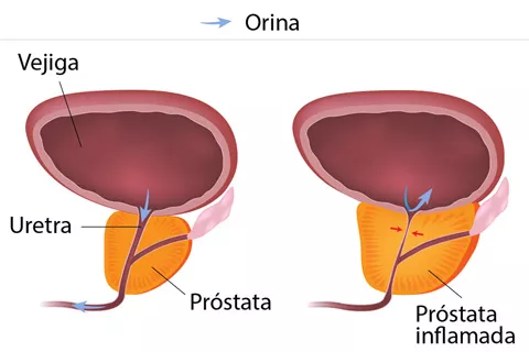 Gráfico de la hiperplasia benigna de próstata