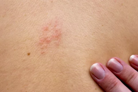 Micosis cutáneas en el cuerpo