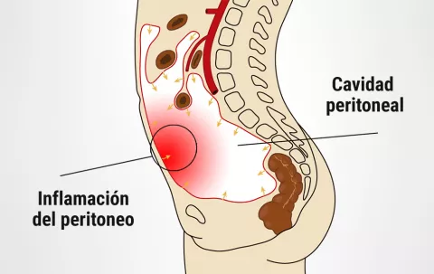 Peritonitis