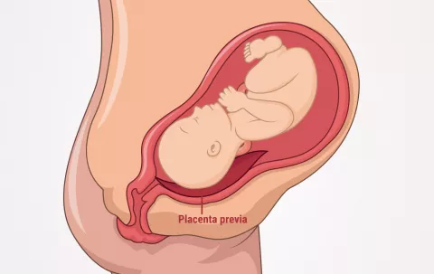 Placenta previa