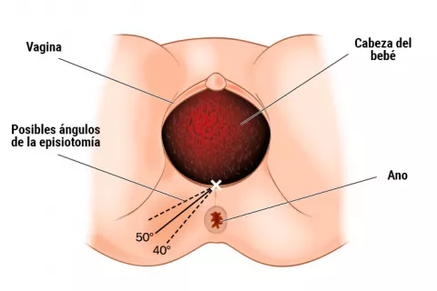 Gráfico de la episiotomia