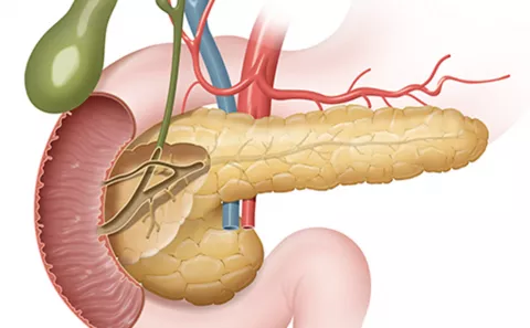 Qué son los tumores exocrinos de páncreas
