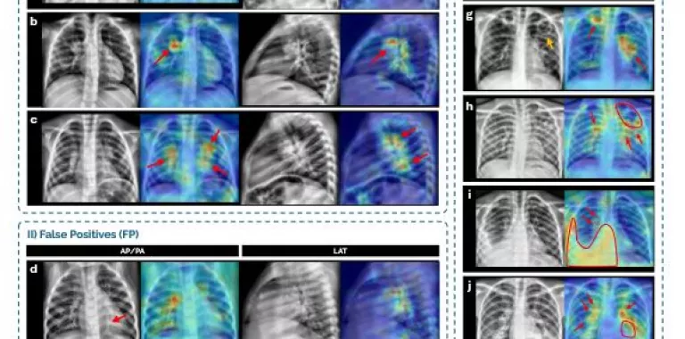 Mapas de activación generados mediante técnicas de explicabilidad que señalan las regiones de interés utilizadas por el modelo para tomar sus decisiones sobre las radiografías Radiografías de tórax