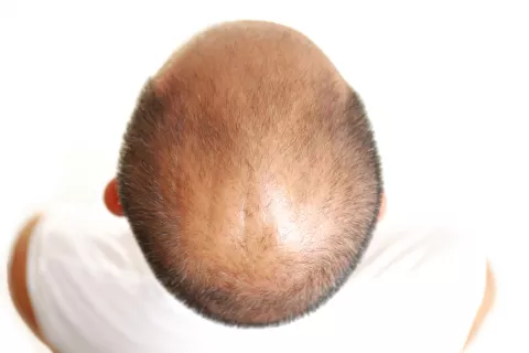 Caballero con alopecia areata