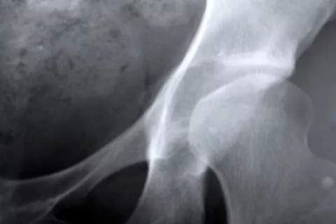 Radiografia de hueso con osteoporosis