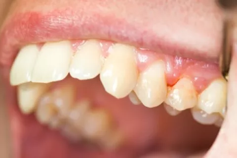 La periodontitis, factor de riesgo cardiovascular