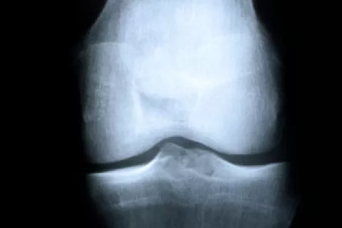 Radiografía de rodilla