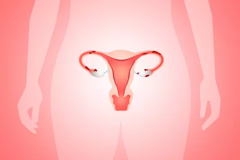 Relacionan la endometriosis con las dioxinas