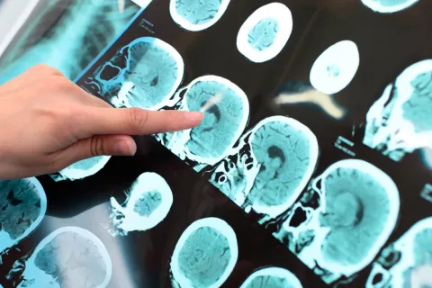 Radiografía del cerebro indicando un posible caso de de alzhéimer