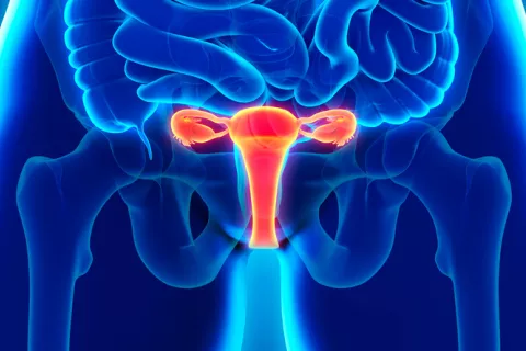 Cáncer de endometrio